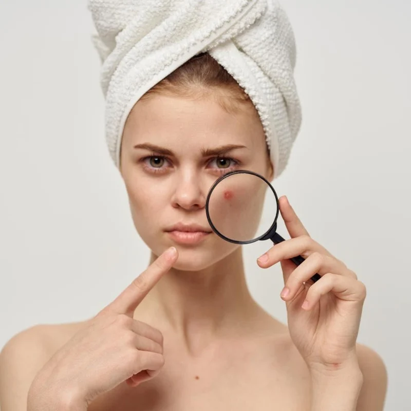 Emulsione Fluida AntiAcne Azione Urto, 50 ml - Alkemilla
